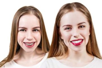 Monthly Payment Plans for Braces Without Insurance
