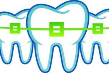 Three teeth with green braces