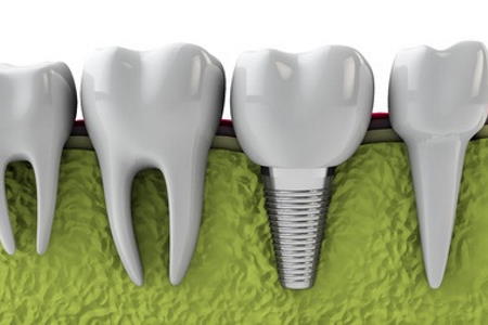 Dental implant surronded by white teeth and green plastic gums