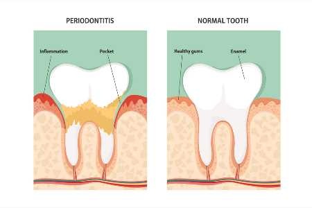 diseased gums versus healthy