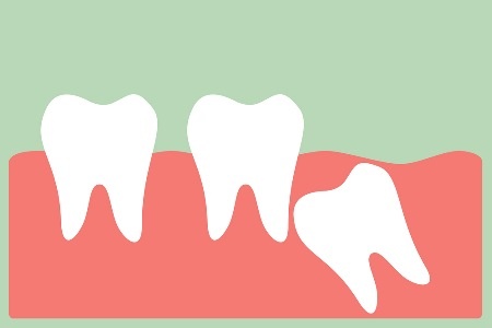 impacted wisdom tooth needing removal