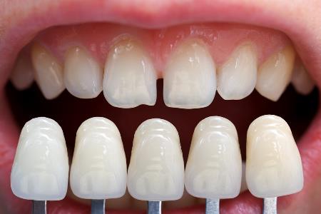 color matching of dental veneers to teeth