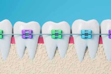 colorful orthodontic braces on teeth