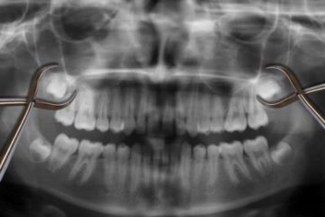 Wisdom teeth x-ray paid by Medicaid